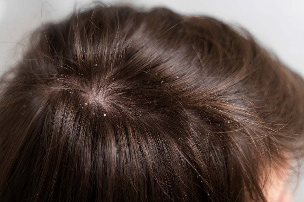 How to Get Rid of Dandruff: Easy Tips and Natural Remedies