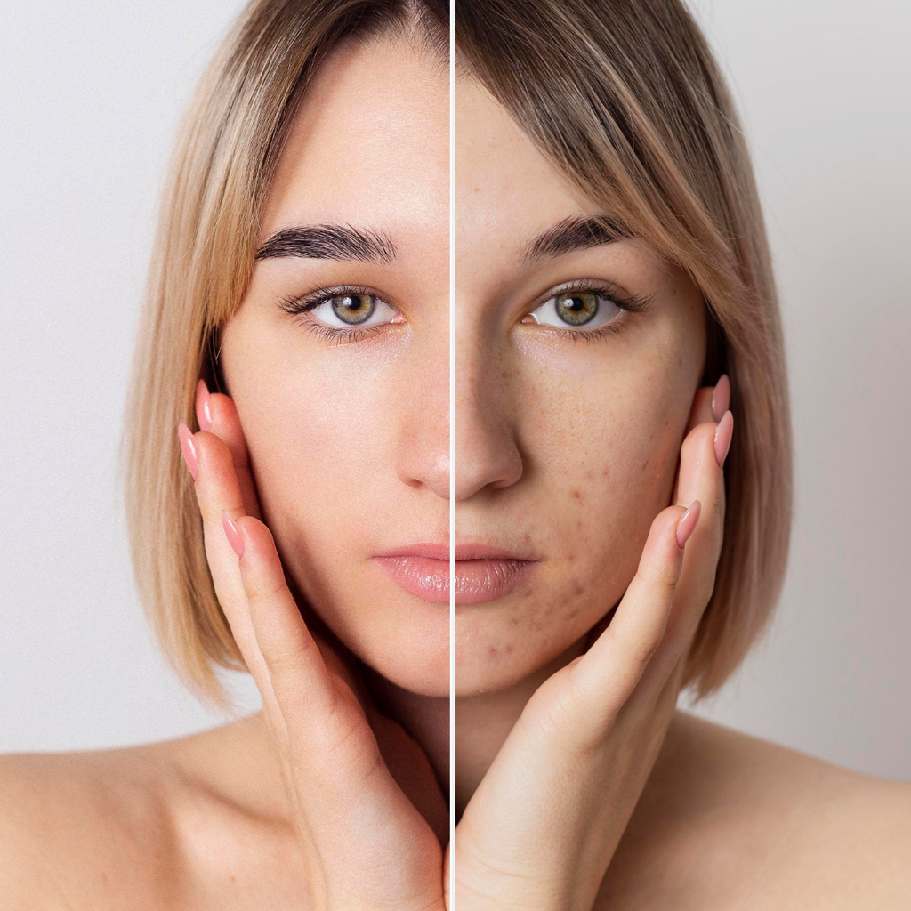 Acne Scars: Identification, Common Types, and Prevention Strategies
